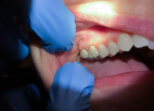 Best Emergency Treatment for Dental Infections or Abscesses in Stottville, NY