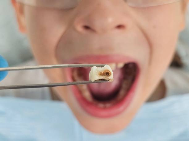 Best Emergency Tooth Extraction in Stottville, NY